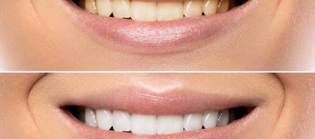 How-Certain-Food-Drinks-Can-Stain-Teeth