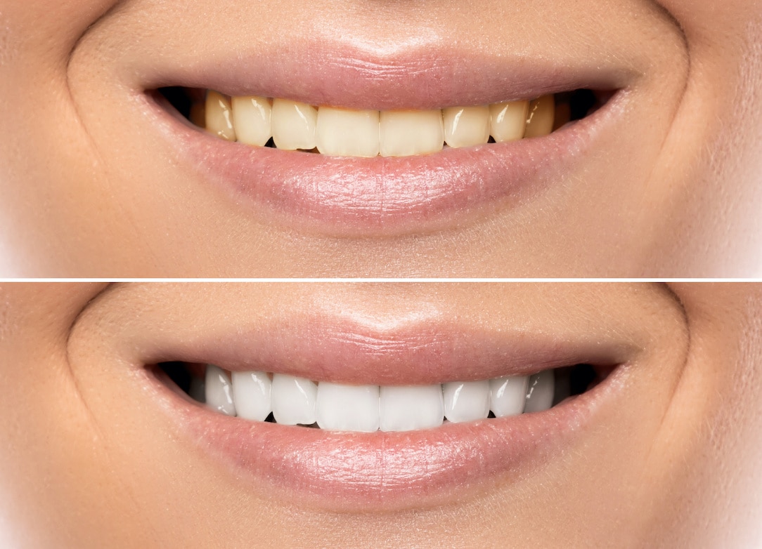 How-Certain-Food-Drinks-Can-Stain-Teeth
