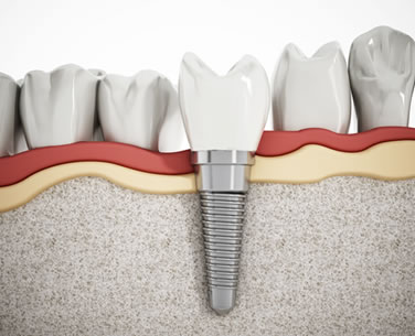 dental implants fort collins
