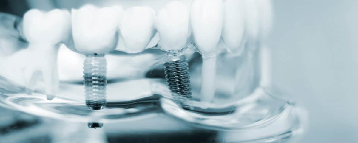 find-out-if-you-qualify-for-dental-implants