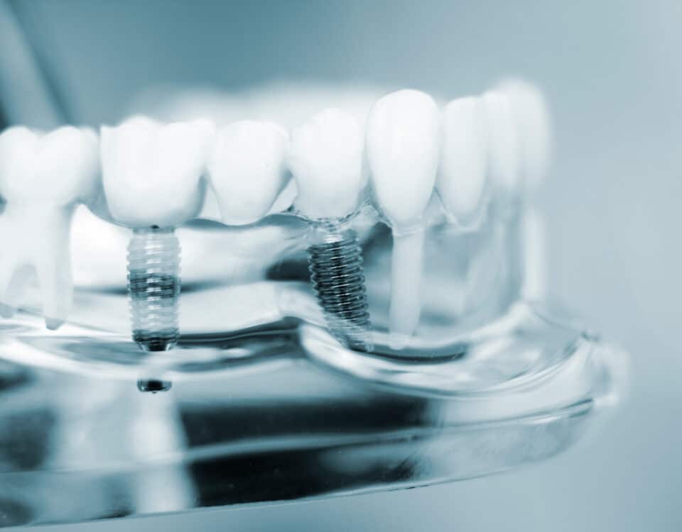 find-out-if-you-qualify-for-dental-implants
