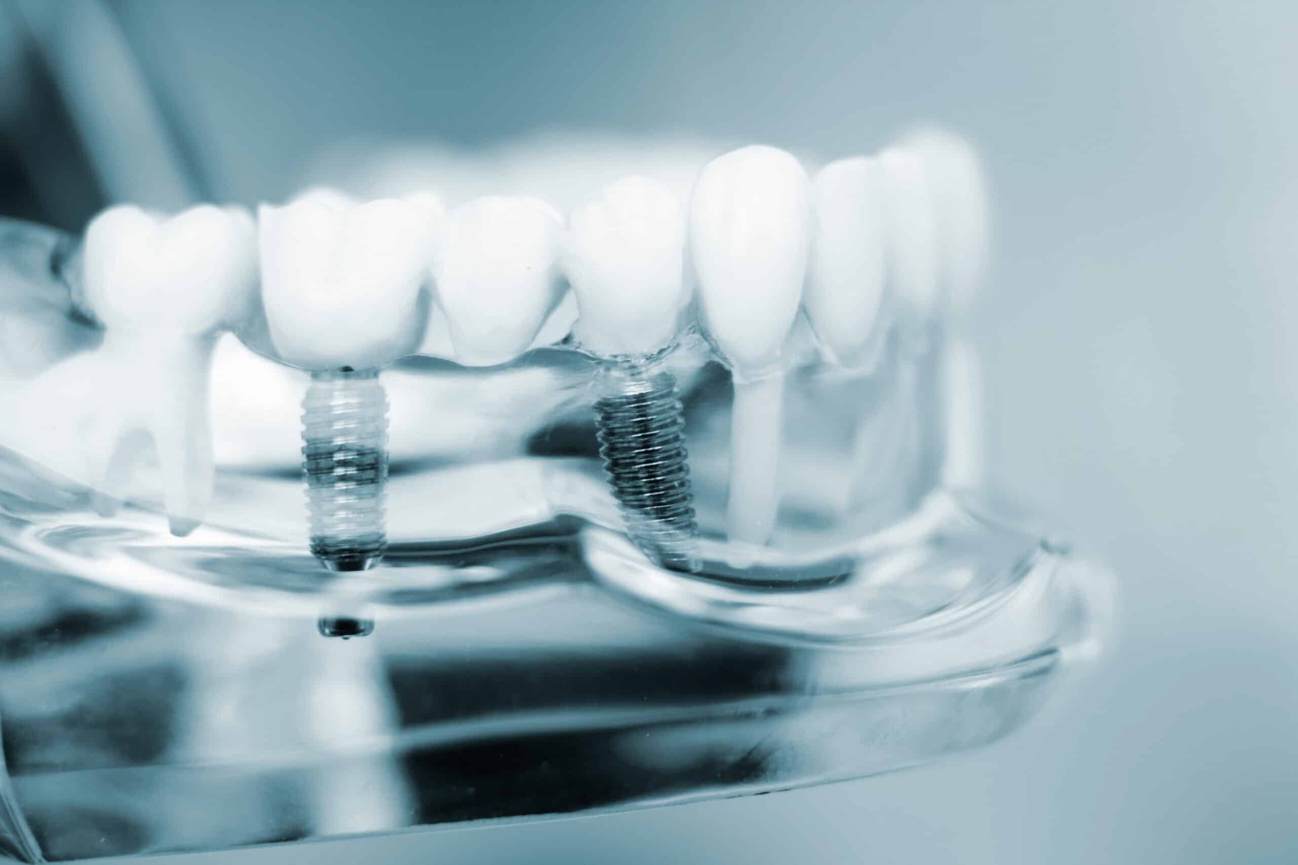 find-out-if-you-qualify-for-dental-implants
