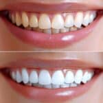 is-it-time-to-whiten-your-smile