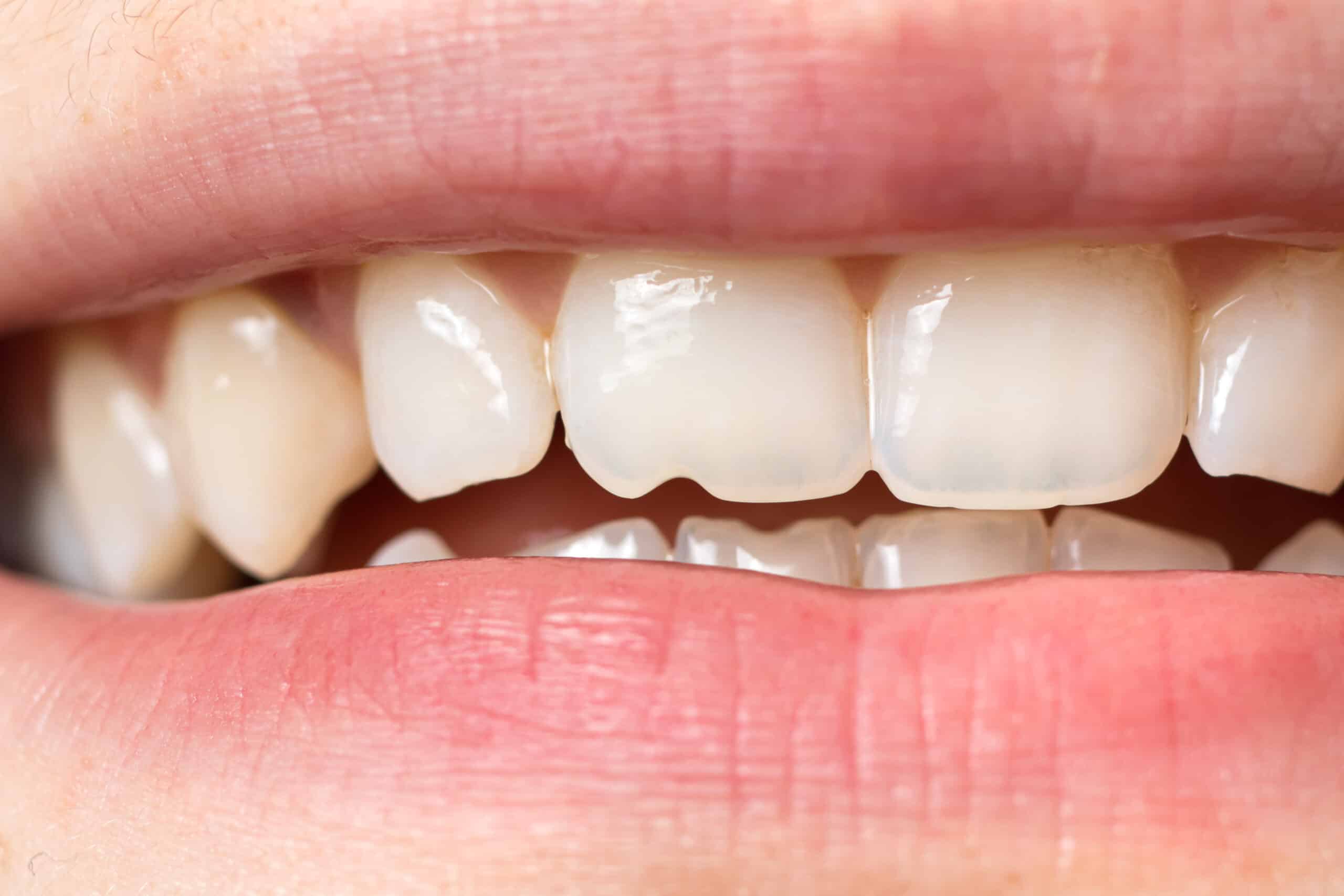 repairing-and-protecting-a-chipped-tooth-what-every-patient-should-know