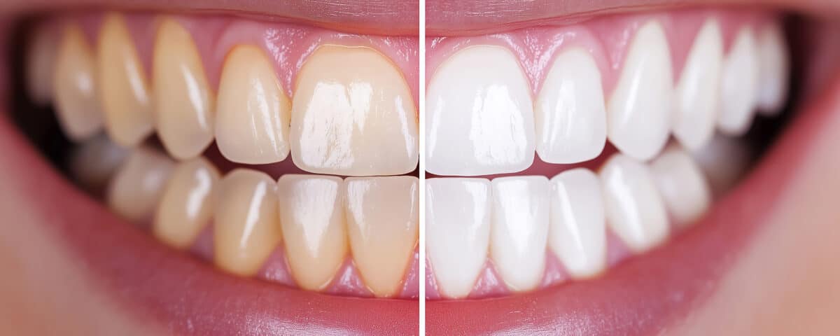 teeth-whitening-beyond-the-basics-creative-ways-to-brighten-your-smile-at-glacier-creek-dental