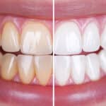 teeth-whitening-beyond-the-basics-creative-ways-to-brighten-your-smile-at-glacier-creek-dental