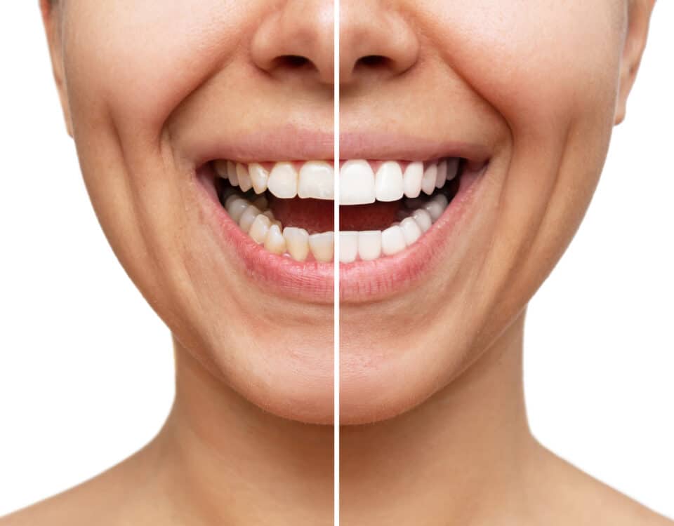 the-all-inclusive-guide-to-getting-dental-veneers