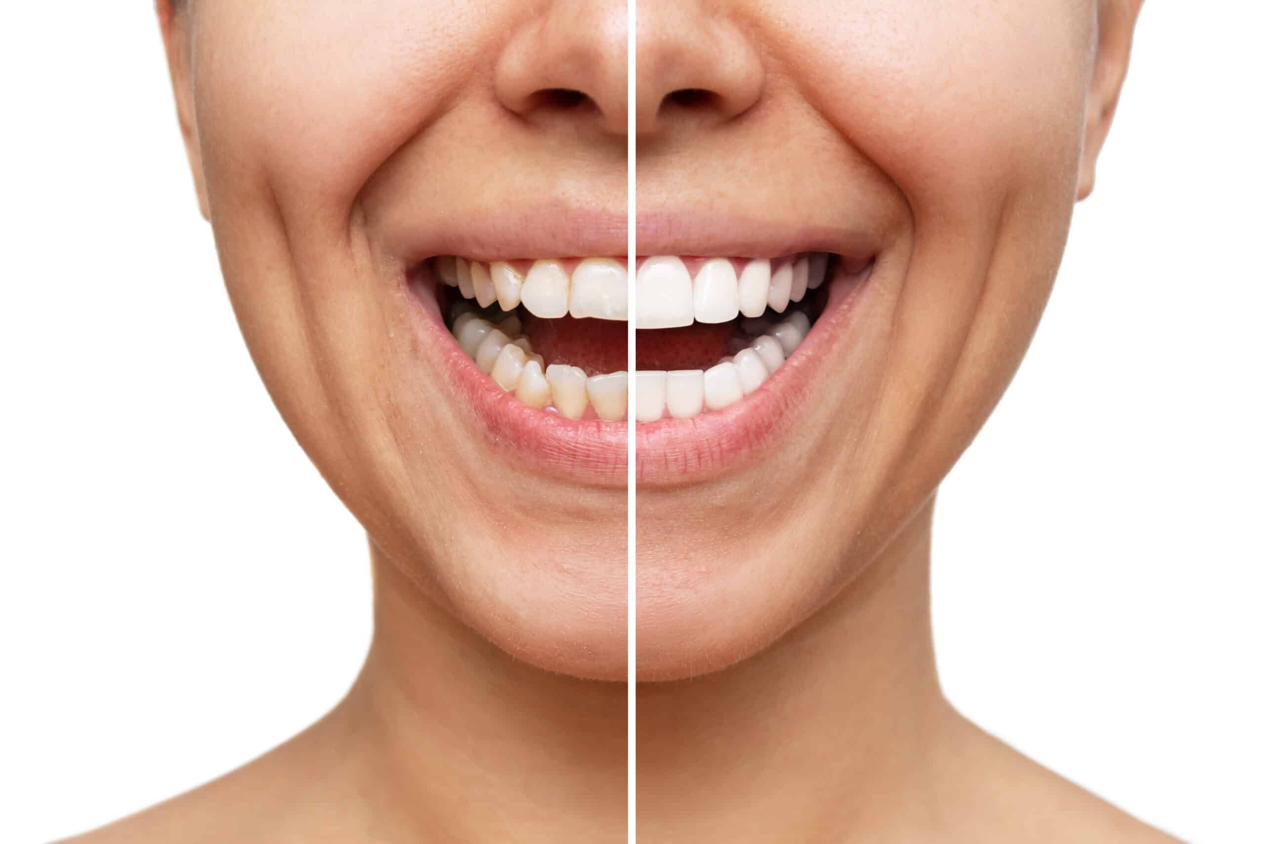 the-all-inclusive-guide-to-getting-dental-veneers