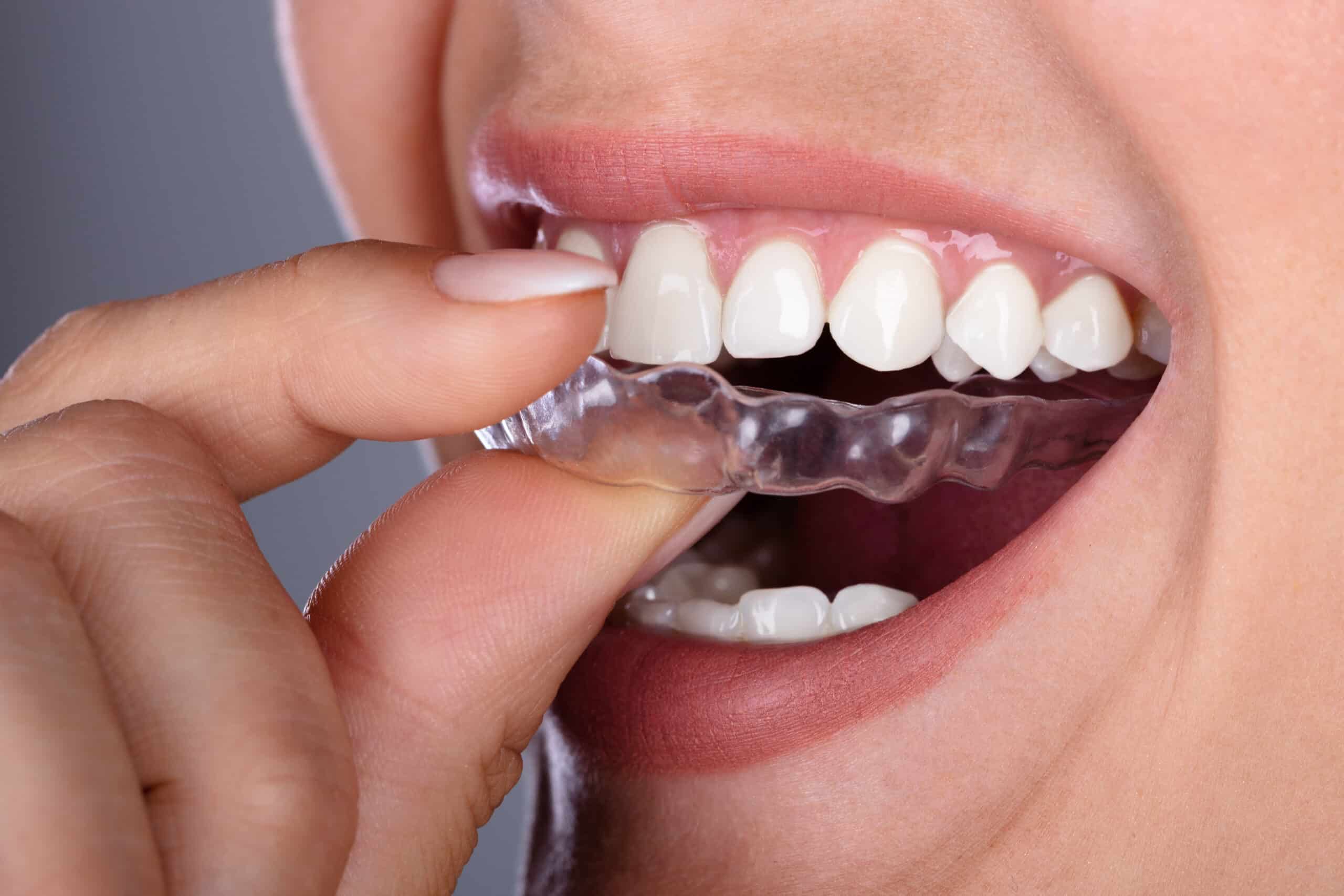 tips-for-ending-bruxism-and-protecting-your-teeth