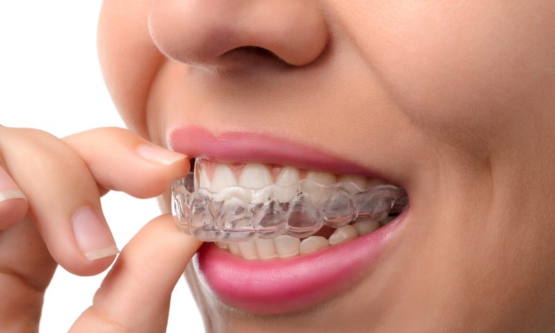 Tips for Using Invisalign®