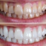 understanding-teeth-stains-types-causes-and-treatments