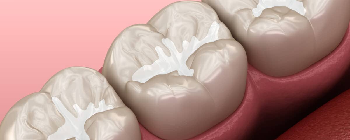 what-is-a-dental-sealant-and-when-should-i-get-one