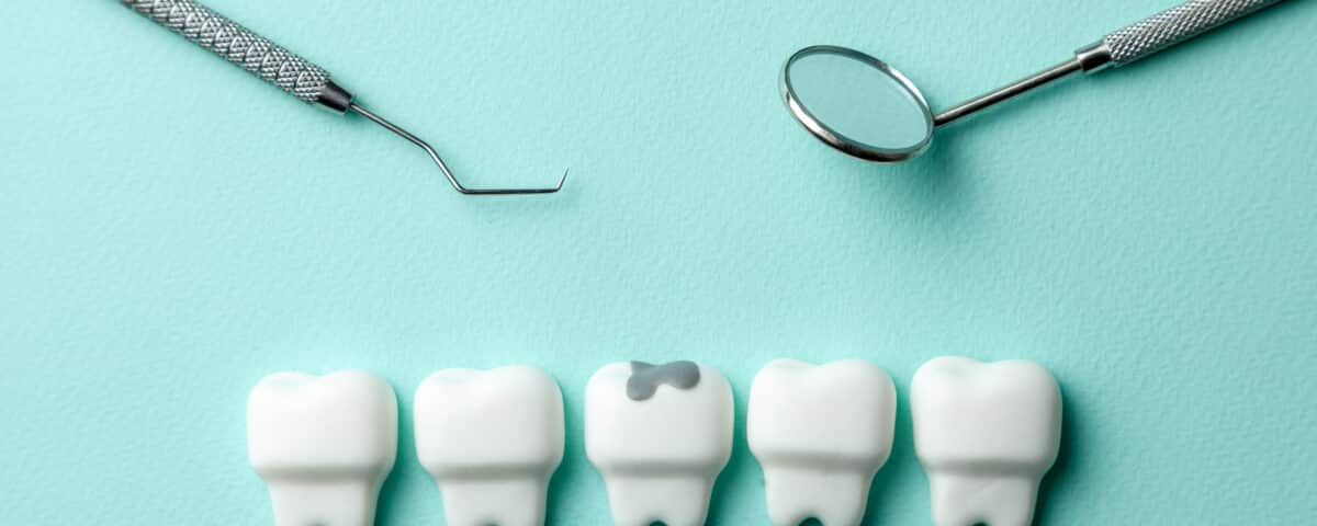 what-to-do-about-cavities