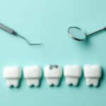 what-to-do-about-cavities