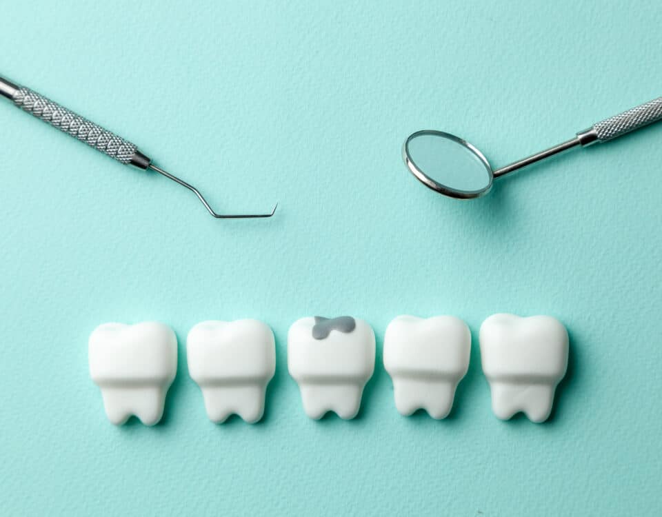 what-to-do-about-cavities