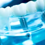 why-dental-implants-are-the-best-solution-for-missing-teeth